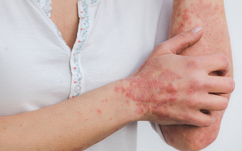 Psoriasis Treatment